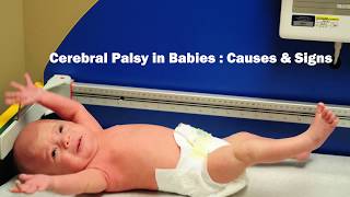 What are the main causes amp signs of Cerebral Palsy in babies  Dr Vykunta Raju K N [upl. by Allyson39]