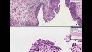 Histopathology Bladder Transitional Carcinomainsitu [upl. by Imehon]