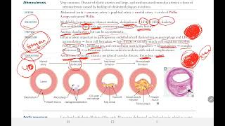 Arteriosclerosis 2  BACK BENCHERS ACADEMY [upl. by Netsryk]