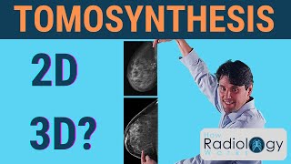 Tomosynthesis Does it offer 3D Mammography [upl. by Eiser]