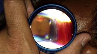 Indirect Ophthalmoscopy with Iphone [upl. by Haziza102]