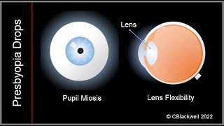 Presbyopia 2 New Treatments with Drops [upl. by Kalvin]