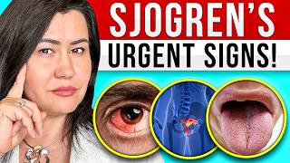 10 Signs of Sjogrens Syndrome  a very complex autoimmune disease [upl. by Yenffad]