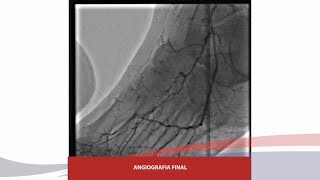 REVASCULARIZACIÓN DE OCLUSIÓN TOTAL DE ARTERIA FEMORAL SUPERFICIAL POPLÍTEA Y TIBIAL POSTERIOR [upl. by Noraj]