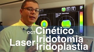 Combinação de lasers Iridotomia e Iridoplastia  OCT cinético do ângulo no glaucoma [upl. by Perni120]