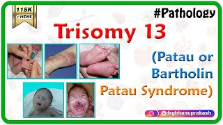 Trisomy 13 Patau or BartholinPatau syndrome  Causes  Diagnosis  Treatment [upl. by Annairdna]