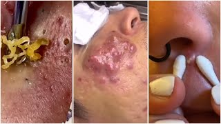 Extremely satisfying blackheads exfoliation for blackheads and pimples TikTok compilation  pt 7 [upl. by Joanie521]