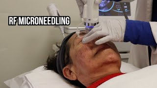 Transform Your Skin with RF Microneedling The Ultimate Beauty Hack [upl. by Enerol]