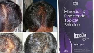 Imxia F Solution Minoxidil amp Finasteride Topical Solution [upl. by Elinor]