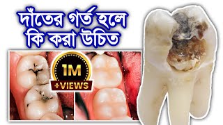 দাঁতের গর্ত হলে কি করবেন  Tooth cavities  Noor Dental JHENAIDAH DentalHealthTips [upl. by Eerhs822]