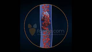 Inferior Vena Cava Filter [upl. by Alrich157]