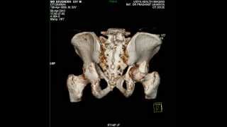 3 D CT SCAN OF FRACTURED RT HIP JOINT [upl. by Nerrag]