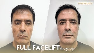 Full facelift with Dr Theerapong Beautiful Natural Results You Can Trust [upl. by Ahsin]