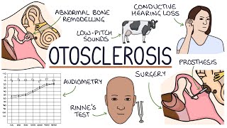 Understanding Otosclerosis [upl. by Attennot]