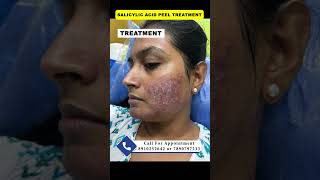 Salicylic acid peel  chemical peel  pimple peeling acne peel druttamkumarlenka acnetreament [upl. by Alanson530]