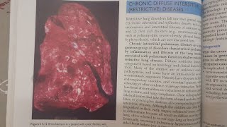 Bronchiectasis  SPECIAL PATHOLOGY [upl. by Biondo]