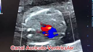 Feto con trisomia 18 síndrome de Edwards trisomia18 sindromedeedwards unifetal colombia bb [upl. by Novick667]