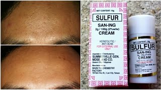 SanIng Sulfur Anti Acne Face Cream Review [upl. by Retrac]