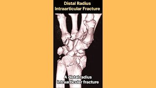 Distal Radius Intraarticular Fracture [upl. by Dukie]