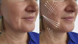 quotUnlock Your Youth The Ultimate Guide to a Scarless Facelift  NonSurgical Beauty Transformationquot [upl. by Ennoira]