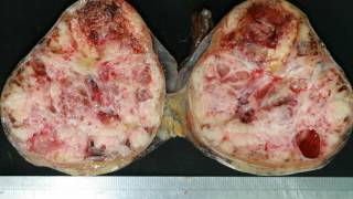 Difference Between Teratoma and Seminoma [upl. by Macrae]