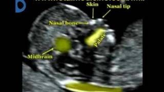 Fetal Medicine Foundation  Nuchal translucency [upl. by Brotherson906]