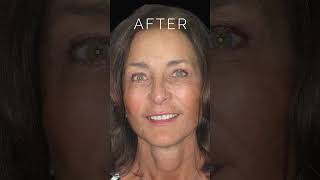 Amazing FACELIFT Before and After Results shorts faceliftsurgery [upl. by Gisela680]