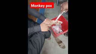 Monkey pox treatment [upl. by Sylvia657]