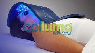 Celluma AntiAcne Light Therapy Treatment Featured in Dermascopes Tools of Skin Care Experts [upl. by Alekram]