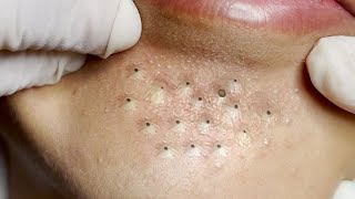 Big Cystic Acne Blackheads Extraction Blackheads amp Milia Whiteheads Removal Pimple Popping  1894 [upl. by Aleras494]