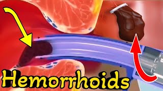 Watch out easiest way to remove Hemorrhoids Piles  3d Animation [upl. by Lossa]