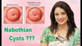 What are Nabothian cyst [upl. by Anirrak517]