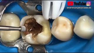 ¡Eliminando caries profunda de una muela [upl. by Gamal]