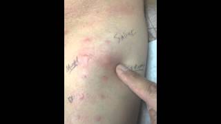 Final allergy skin test [upl. by Arelus121]