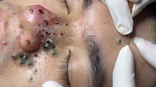 Big Cystic Acne Blackheads Extraction Blackheads amp Milia Whiteheads Removal Pimple Popping 0034💆 [upl. by Yebloc]