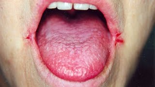 Angular Cheilitis ReviewHow To Treat Angular Cheilitis [upl. by Sisco]