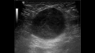 What is GALACTOCELE Blocked Milk Ducts [upl. by Willumsen]