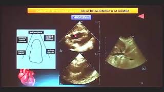 ECOCARDIOGRAFIA EN LOS DISTINTOS TIPOS DE SHOCK [upl. by Epstein]