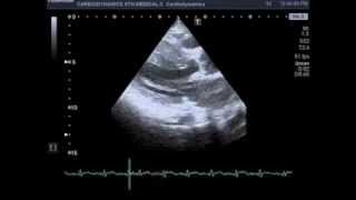 HCM with rupture of mitral chordae tendineae [upl. by Aihsekram]