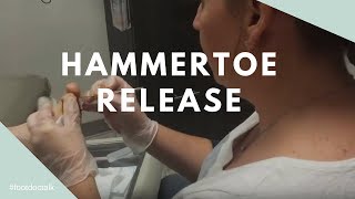 Hammertoe Tendon Release [upl. by Drummond]