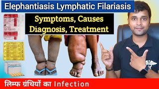 Elephantiasis  Filariasis  Symptoms Causes Diagnosis Treatment Prevention In Hindi [upl. by Ordnajela]