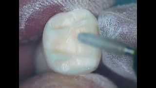 Crown Preparation Tooth Number 30 Part 1 [upl. by Parrott]