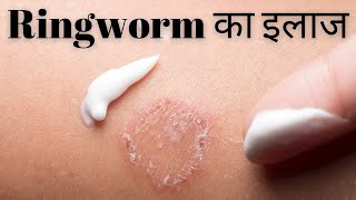 Ringworm infection  Ringworm home treatment  daad ka ilaj  daad treatment  दाद का इलाज [upl. by Anihcak]