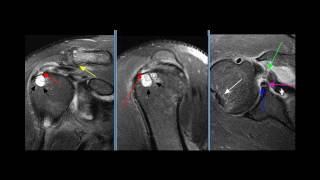 Shoulder MRI Case 3 [upl. by Aleka]