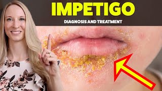 BEARD RASH IMPETIGO Diagnosis Treatment and Home Tips Explained by a Dermatologist [upl. by Ariamat]