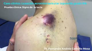 EXAMEN FÍSICO DE LUXACIÓN ACROMIOCLAVICULAR GRADO IIIB [upl. by Nedah464]