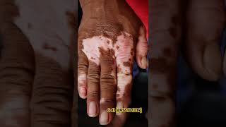 Vitiligo skin colouring safeddaag ilaj vitiligo micropigmention vitiligotreatment microvitiligo [upl. by Accebber619]