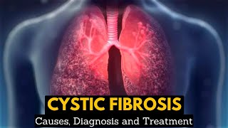 CYSTIC FIBROSIS Causes Signs and Symptoms Diagnosis and Treatment [upl. by Nitsraek]