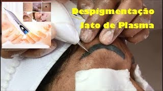 DESPIGMENTAÇÃO COM JATO DE PLASMA Protocolo Despigmentação de Sobrancelhas [upl. by Enahpets328]