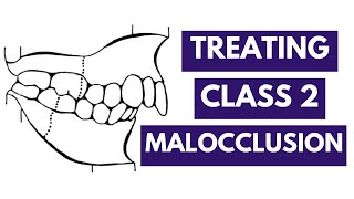 Management of Class 2 Malocclusion Orthodontics [upl. by Beck]